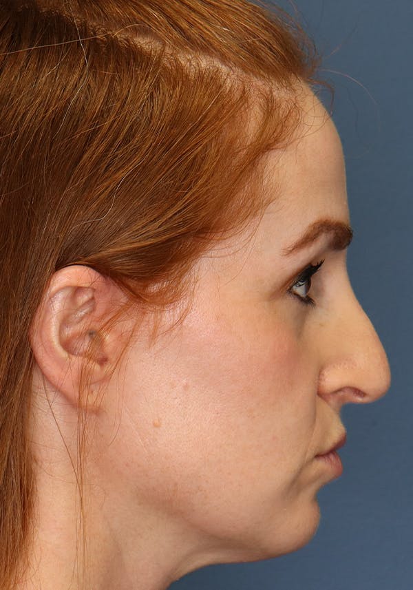 Aesthetic Rhinoplasty Before & After Gallery - Patient 35802290 - Image 9