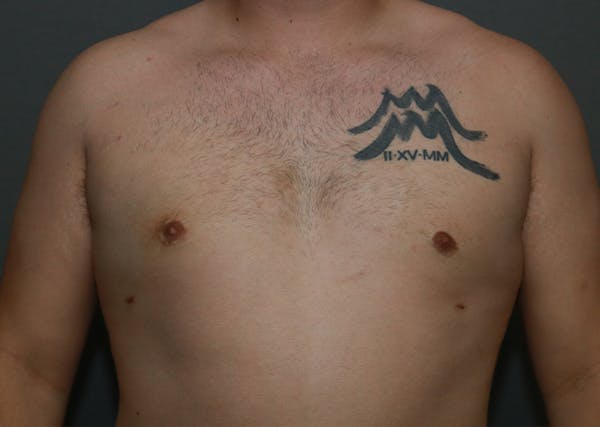 Gynecomastia Before & After Gallery - Patient 35803975 - Image 2