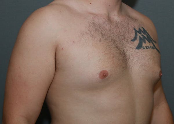 Gynecomastia Before & After Gallery - Patient 35803975 - Image 3