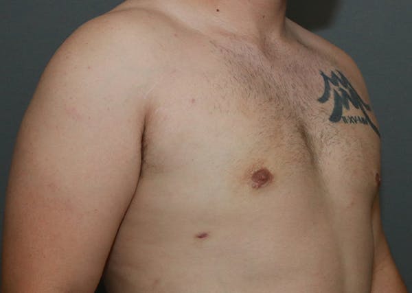 Gynecomastia Before & After Gallery - Patient 35803975 - Image 4