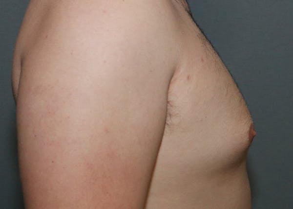 Gynecomastia Before & After Gallery - Patient 35803975 - Image 5
