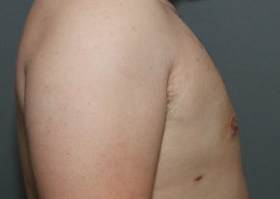 Gynecomastia Before & After Gallery - Patient 35803975 - Image 6