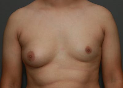 Gynecomastia Before & After Gallery - Patient 35803980 - Image 1