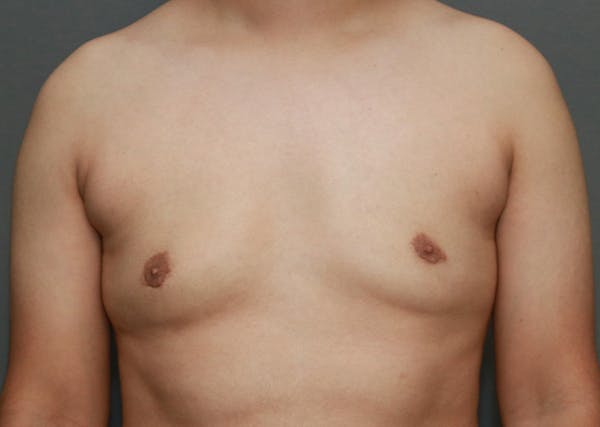 Gynecomastia Before & After Gallery - Patient 35803980 - Image 2