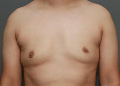 Gynecomastia Before & After Gallery - Patient 35803980 - Image 2