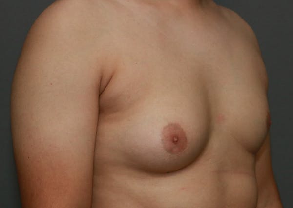 Gynecomastia Before & After Gallery - Patient 35803980 - Image 3