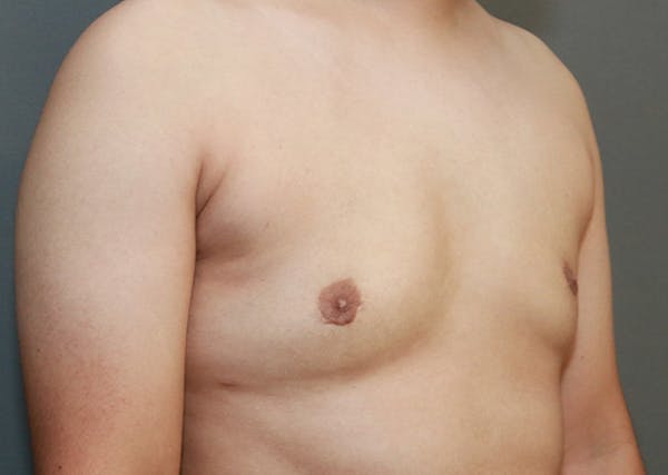 Gynecomastia Before & After Gallery - Patient 35803980 - Image 4