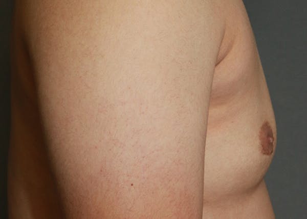 Gynecomastia Before & After Gallery - Patient 35803980 - Image 6