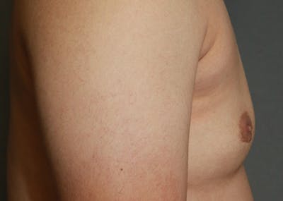 Gynecomastia Before & After Gallery - Patient 35803980 - Image 6