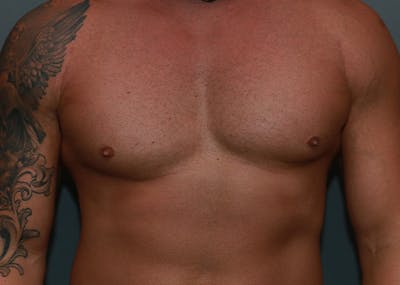 Gynecomastia Before & After Gallery - Patient 35811119 - Image 1
