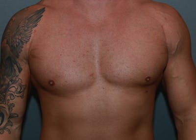 Gynecomastia Before & After Gallery - Patient 35811119 - Image 2