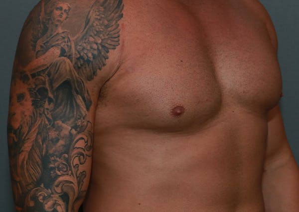 Gynecomastia Before & After Gallery - Patient 35811119 - Image 3