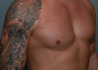 Gynecomastia Before & After Gallery - Patient 35811119 - Image 4