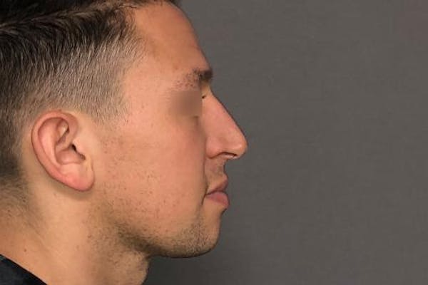 Functional Rhinoplasty Before & After Gallery - Patient 37535479 - Image 3