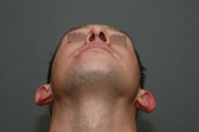 Functional Rhinoplasty Before & After Gallery - Patient 37535479 - Image 6