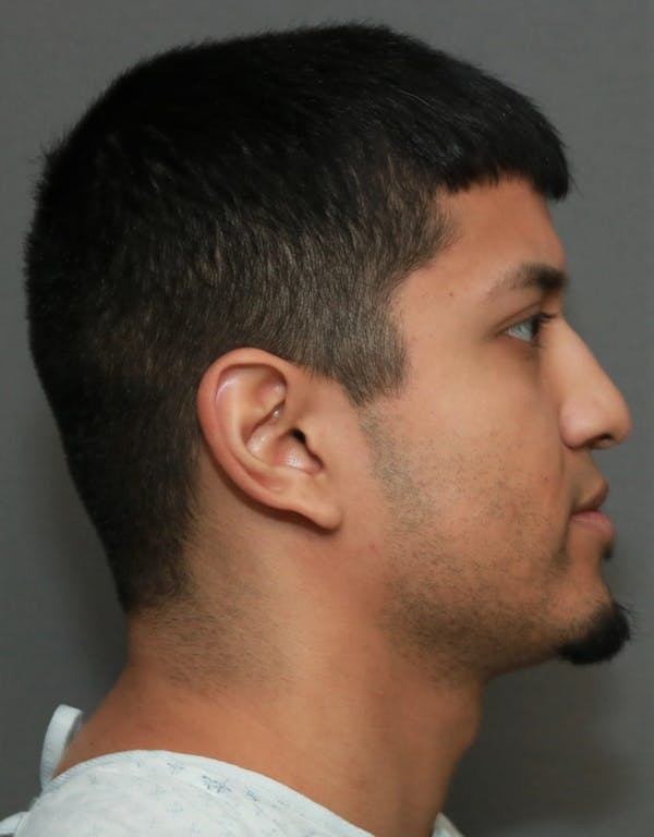 Functional Rhinoplasty Before & After Gallery - Patient 37535480 - Image 5