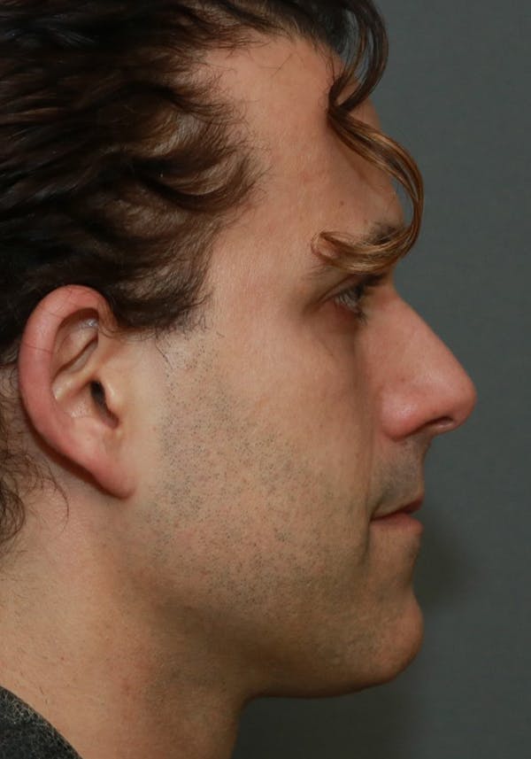 Functional Rhinoplasty Before & After Gallery - Patient 37535481 - Image 5