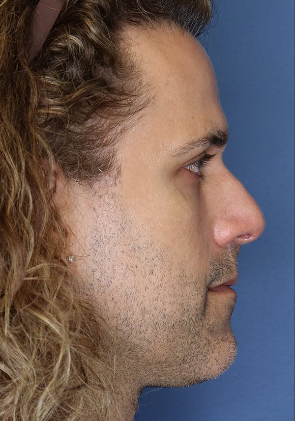 Functional Rhinoplasty Before & After Gallery - Patient 37535481 - Image 6