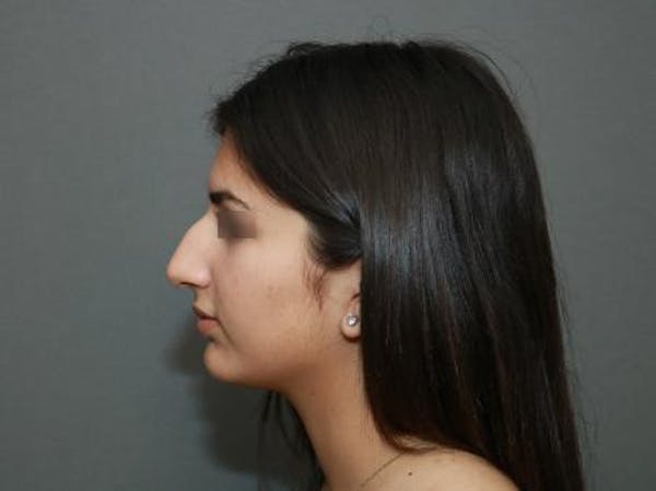 Aesthetic Rhinoplasty Before & After Gallery - Patient 37536268 - Image 5