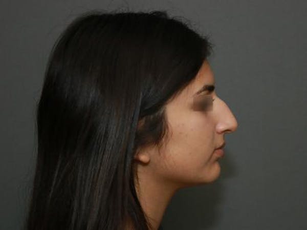 Aesthetic Rhinoplasty Before & After Gallery - Patient 37536268 - Image 9