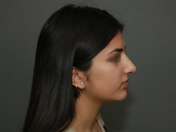 Aesthetic Rhinoplasty Before & After Gallery - Patient 37536268 - Image 10