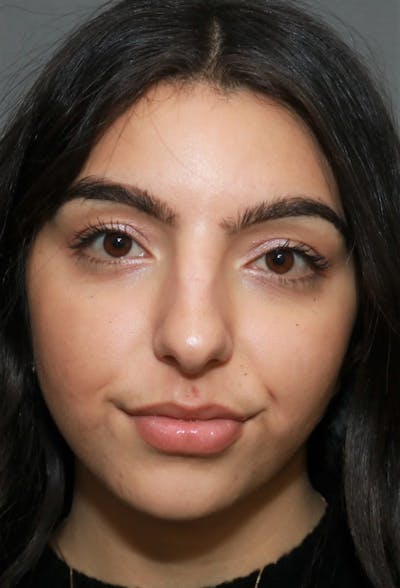 Aesthetic Rhinoplasty Before & After Gallery - Patient 37536273 - Image 1