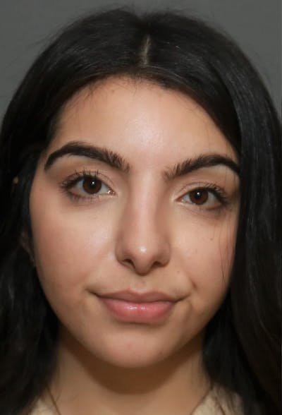 Aesthetic Rhinoplasty Before & After Gallery - Patient 37536273 - Image 2