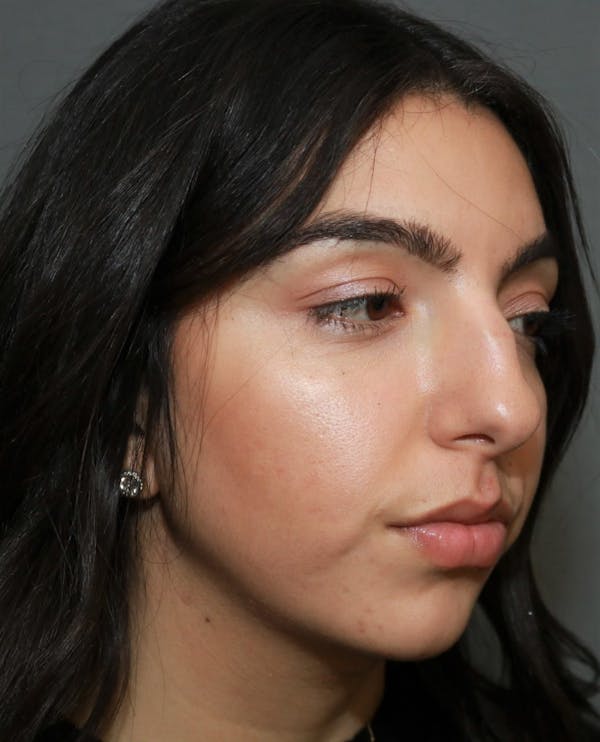 Aesthetic Rhinoplasty Before & After Gallery - Patient 37536273 - Image 3