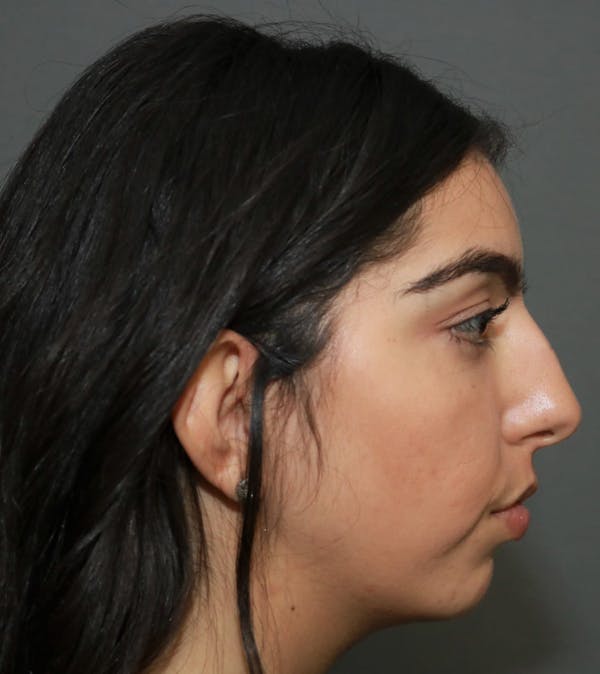 Aesthetic Rhinoplasty Before & After Gallery - Patient 37536273 - Image 5