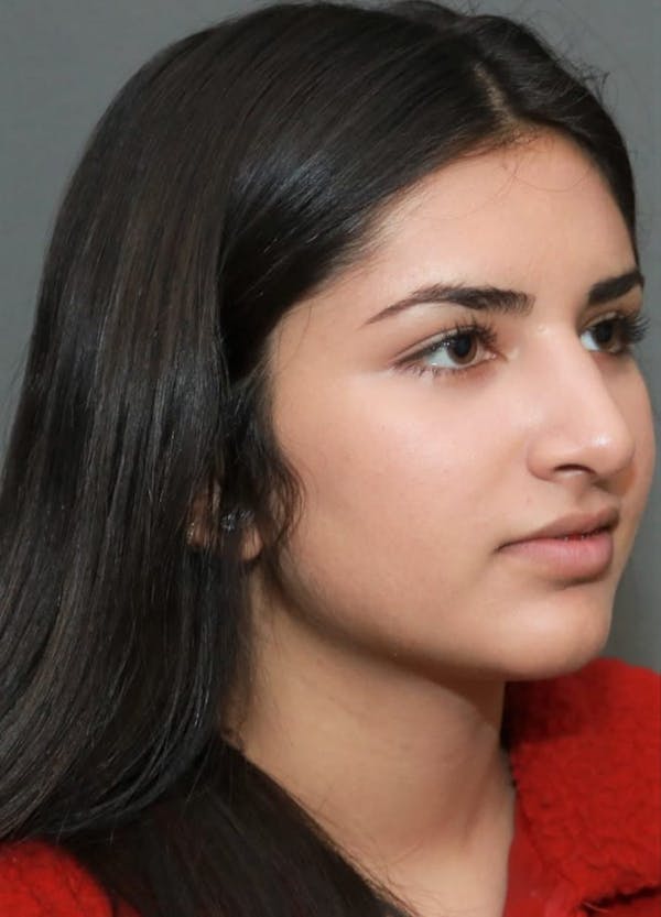 Aesthetic Rhinoplasty Before & After Gallery - Patient 37536317 - Image 4