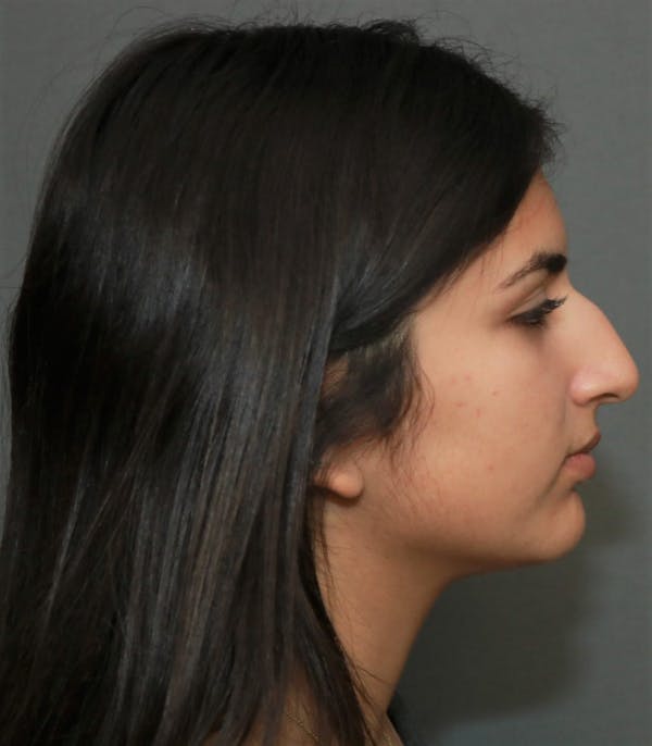 Aesthetic Rhinoplasty Before & After Gallery - Patient 37536317 - Image 5