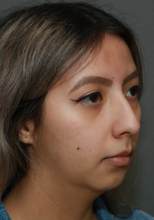 Aesthetic Rhinoplasty Before & After Gallery - Patient 37536322 - Image 3