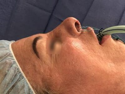 Aesthetic Rhinoplasty Before & After Gallery - Patient 37536343 - Image 1