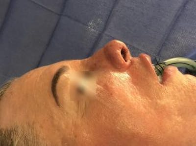 Aesthetic Rhinoplasty Before & After Gallery - Patient 37536343 - Image 2