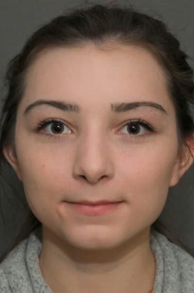 Functional Rhinoplasty Before & After Gallery - Patient 5070449 - Image 2
