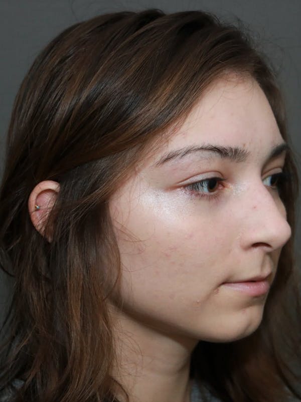 Functional Rhinoplasty Before & After Gallery - Patient 5070449 - Image 3