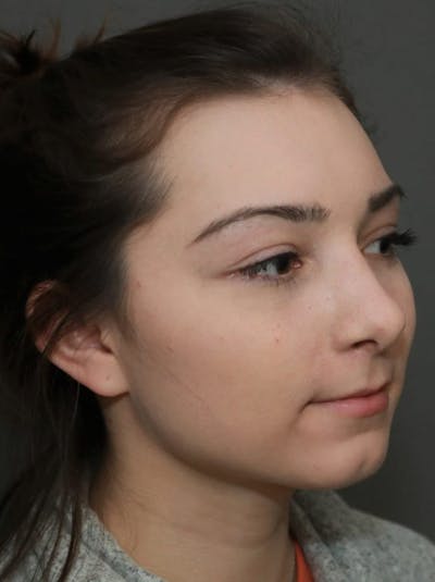 Functional Rhinoplasty Before & After Gallery - Patient 5070449 - Image 4