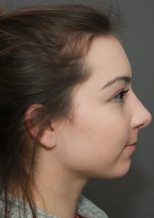 Functional Rhinoplasty Before & After Gallery - Patient 5070449 - Image 5