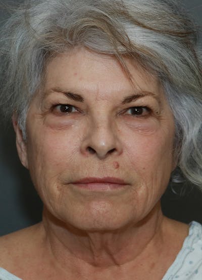 Facelift Before & After Gallery - Patient 44812279 - Image 1