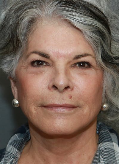 Facelift Before & After Gallery - Patient 44812279 - Image 2
