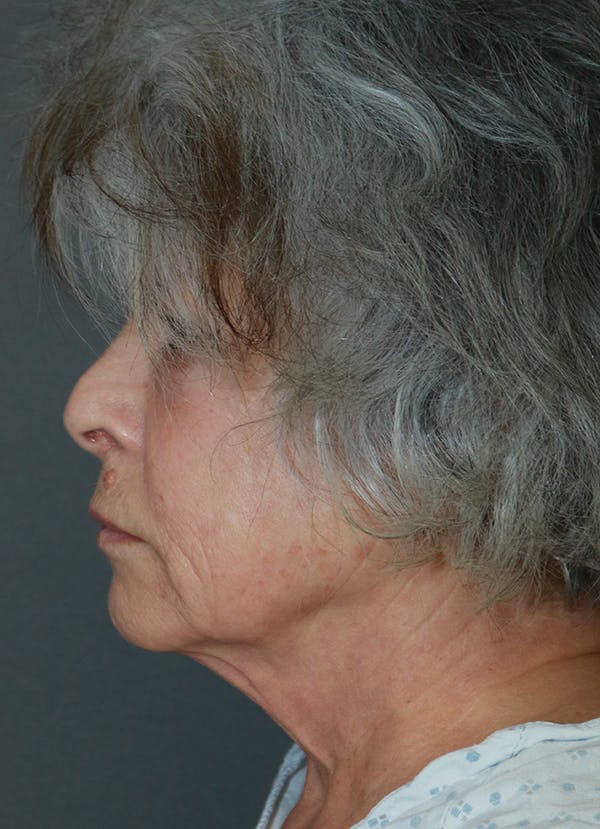 Facelift Before & After Gallery - Patient 44812279 - Image 5