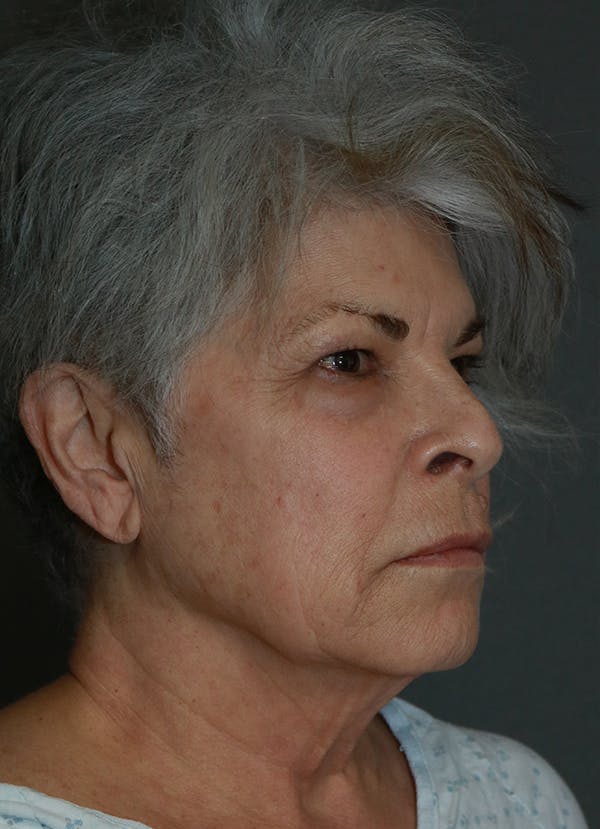 Facelift Before & After Gallery - Patient 44812279 - Image 7