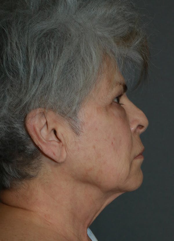 Facelift Before & After Gallery - Patient 44812279 - Image 9