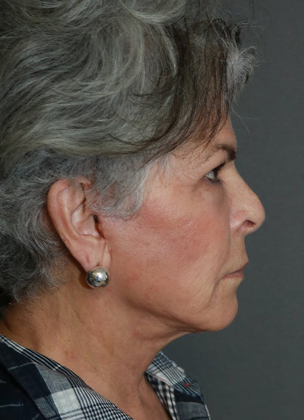Facelift Before & After Gallery - Patient 44812279 - Image 10