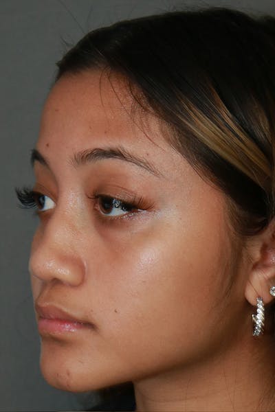 Functional Rhinoplasty Before & After Gallery - Patient 44812284 - Image 4