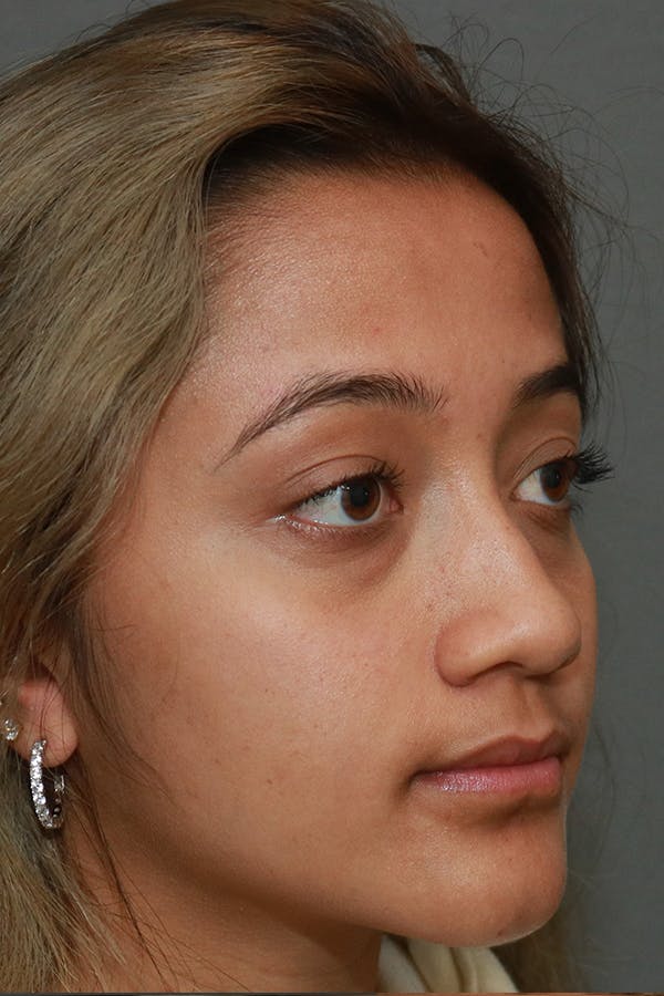 Functional Rhinoplasty Before & After Gallery - Patient 44812284 - Image 7