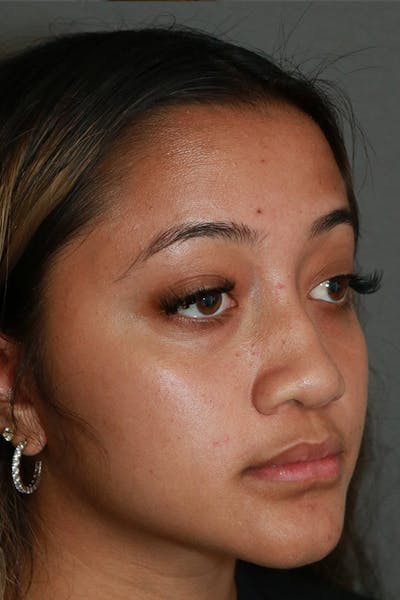 Functional Rhinoplasty Before & After Gallery - Patient 44812284 - Image 8