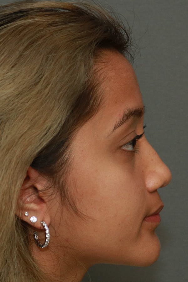 Functional Rhinoplasty Before & After Gallery - Patient 44812284 - Image 9