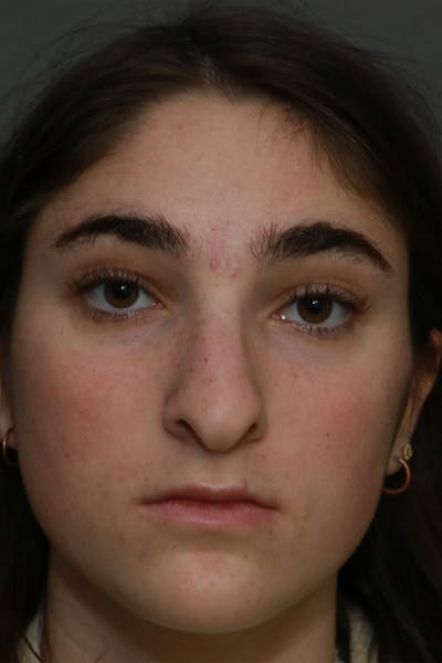 Aesthetic Rhinoplasty Before & After Gallery - Patient 44812332 - Image 1