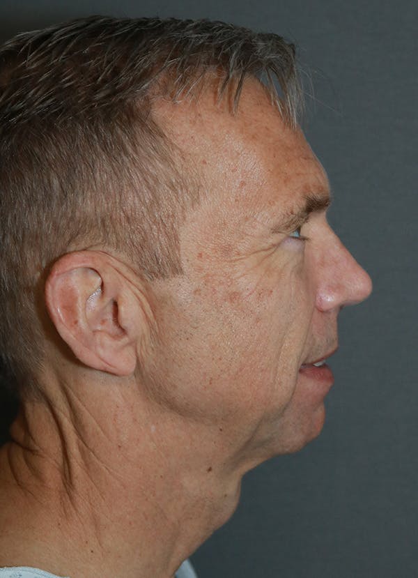 Facelift Before & After Gallery - Patient 48085512 - Image 5